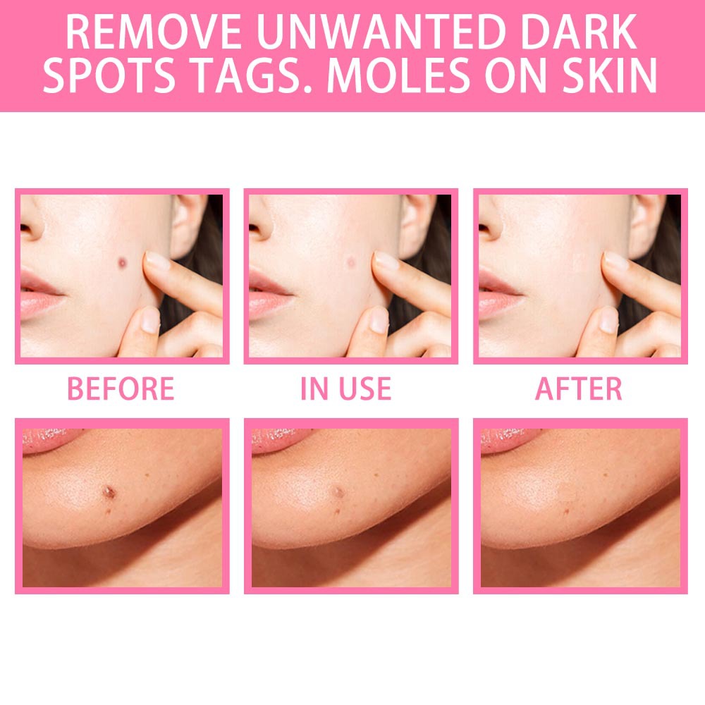 Organic Tags Solutions Serum No Trace Painle Skin Tag Remover Serum Mole Removal Cream Painless Face Wart Mole Freckle